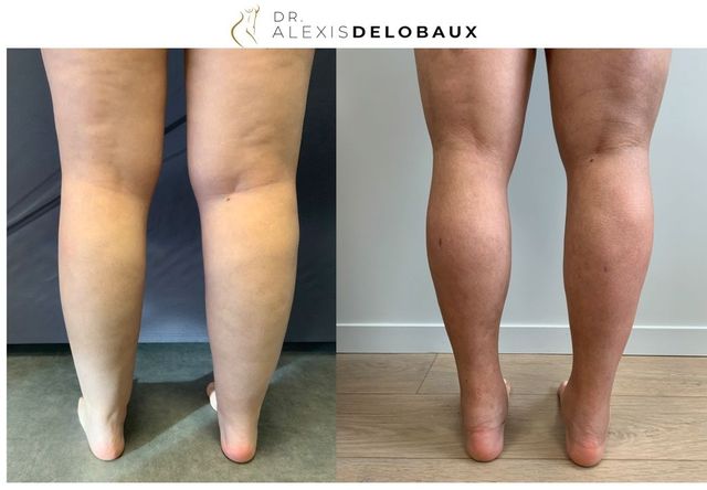 Liposuccion des Bras et Lipoaspiration Bordeaux Dr. Delobaux